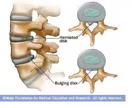 What’s the Difference Between a Herniated and Bulging Disc?